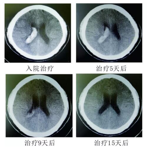 腦出血你不得不引起重視的疾病?。?！