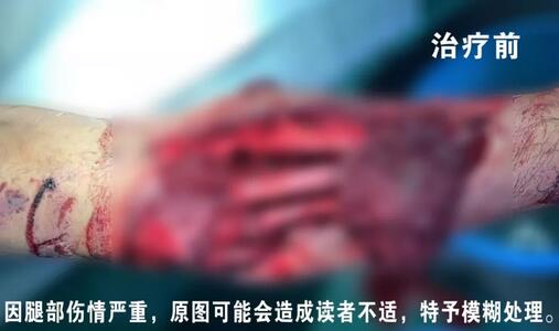 感謝安利醫(yī)院挽救了我的腿，沒有讓我落下殘疾……”