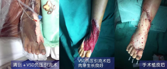 車禍猛如虎，救治如“華佗” ，手術＋康復，8歲小女孩車禍后日漸康復行走
