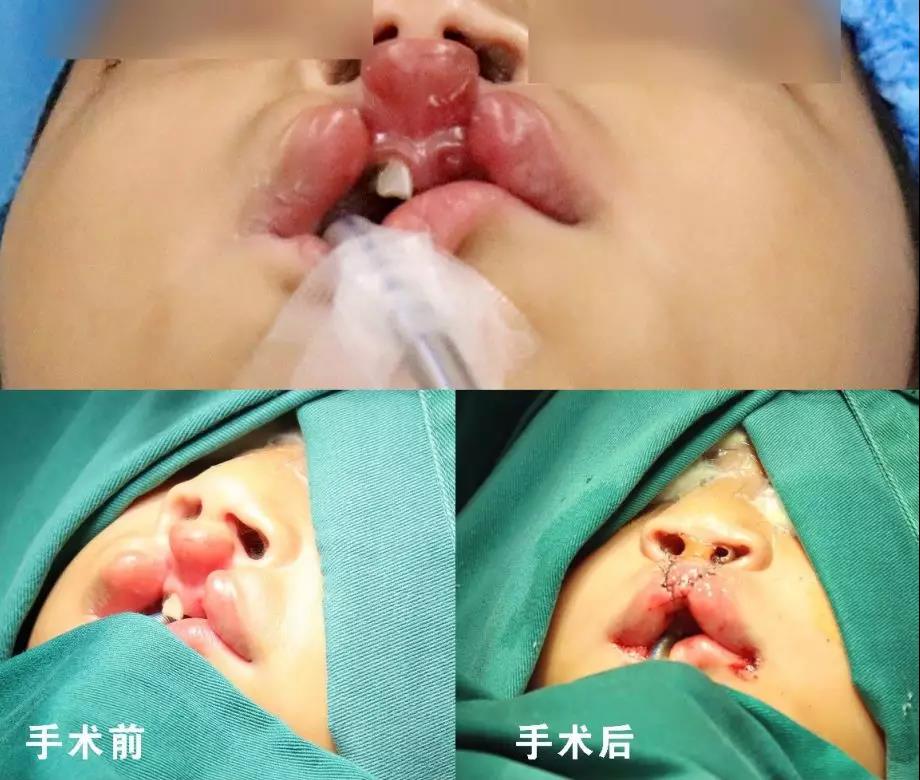 唇腭裂盡早治療消除孩子自卑心理，快樂成長！