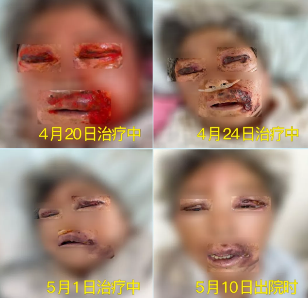 膿毒血癥（急性頜面部蜂窩組織炎）多學科聯合會診，幫助患者成功治愈！