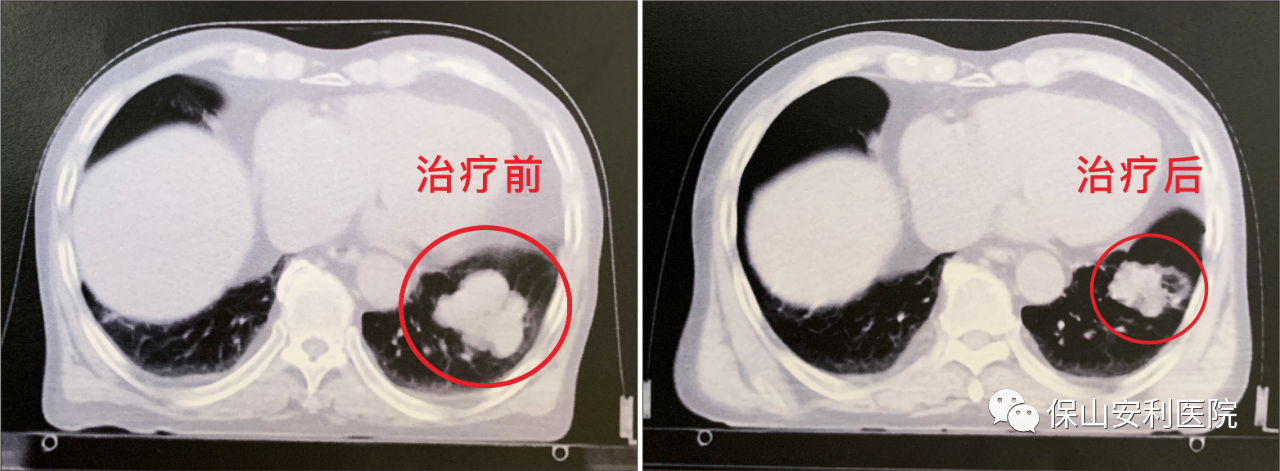 不做手術(shù)，早期肺癌也能根治！