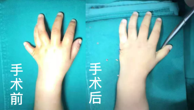 【保山安利醫(yī)院】2歲小兒手、足多指（趾）成功修復(fù)(矯正）！