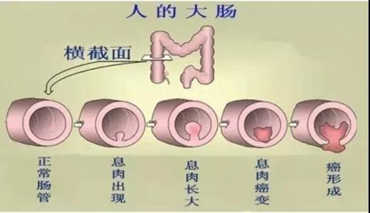 體檢發(fā)現(xiàn)腸息肉會癌變嗎？