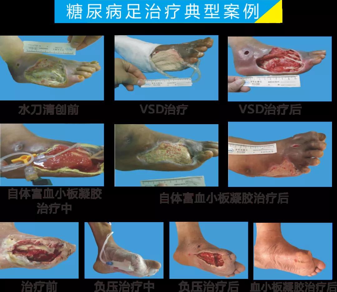 截肢、失明，甚至……，我們要做的是將糖尿病并發(fā)癥遏制在搖籃里！