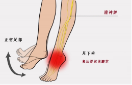 【保山安利醫(yī)院—健康科普】什么是足下垂！你了解嗎？