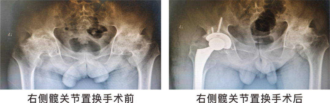 【保山安利醫(yī)院】長(zhǎng)期飲酒導(dǎo)致雙側(cè)股骨頭壞死，髖關(guān)節(jié)置換后重獲運(yùn)動(dòng)功能！