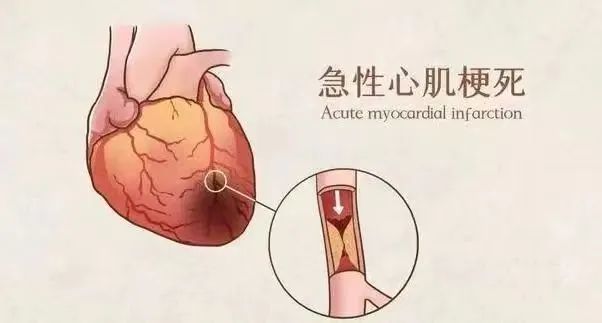 【保山安利醫(yī)院】11月20日“心梗救治日” 時間就是心肌，時間就是生命！